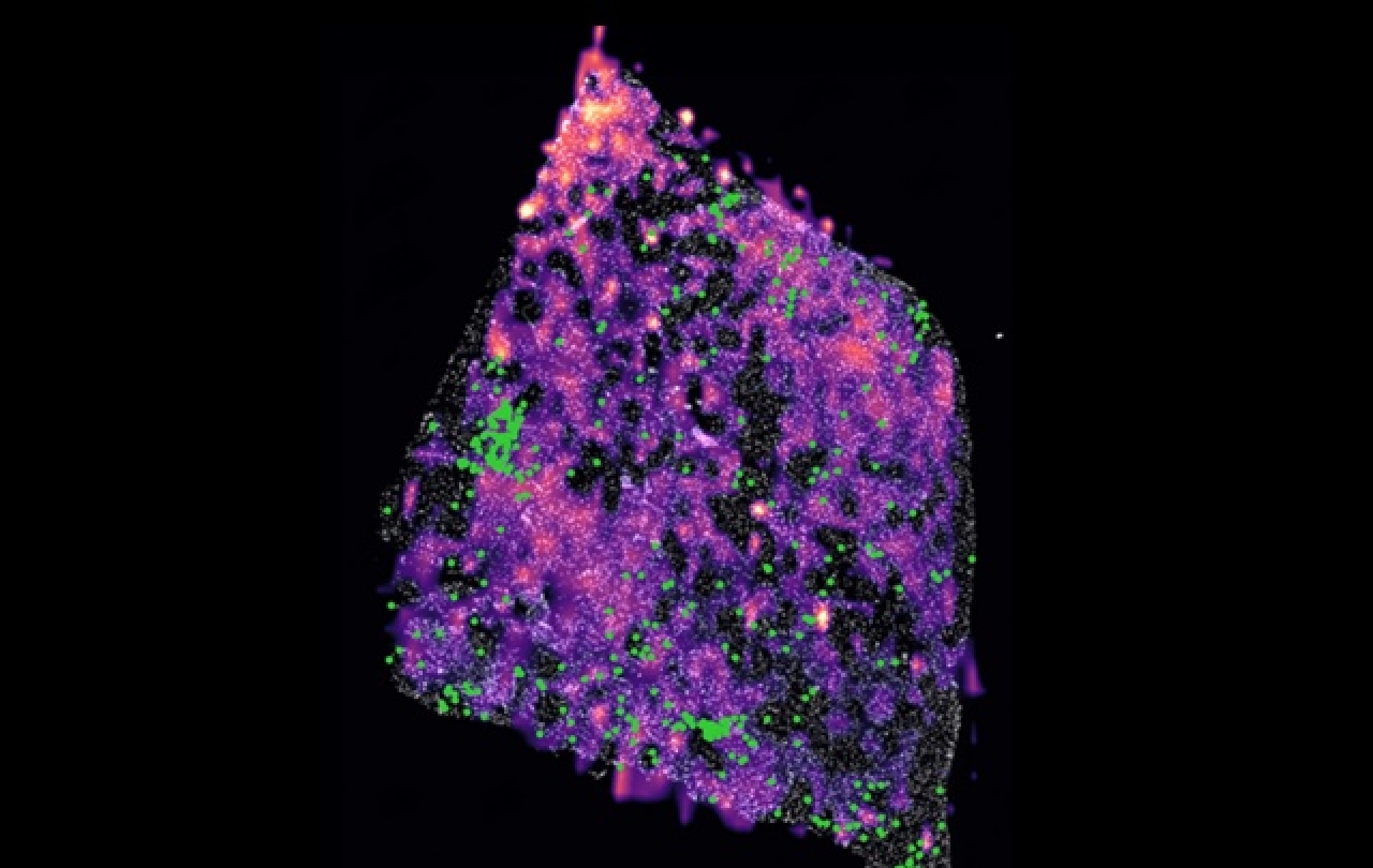 Tumor de glioma humà amb una mutació que mostra grups de cèl·lules T en verd i els punts rosa representen concentracions del metabòlit D2H-C 